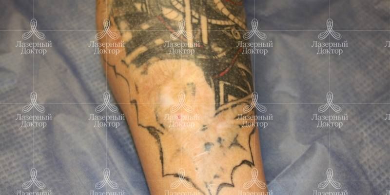 Результат удаления татуировки хирургическим лазером
