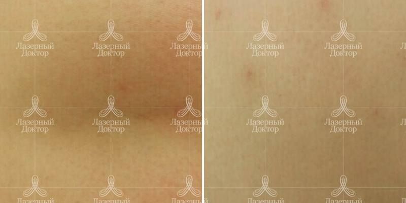 Лечение шрамов лазером (фото до и после)