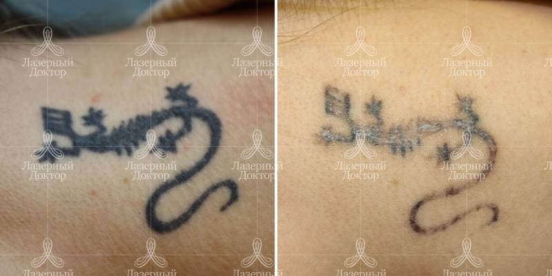 Сведение татуировки с лица (фото до и после)