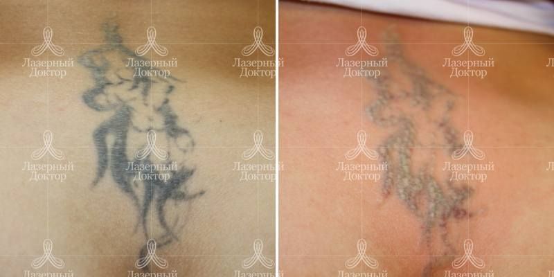 Удаление татуировок лазером: фото до и после