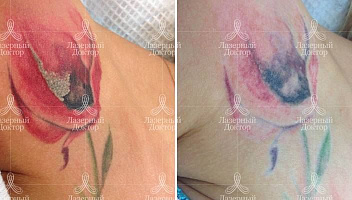 Лазерное удаление татуировки на теле